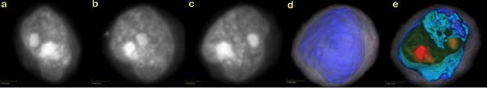 Squamous_Cancer_Cell